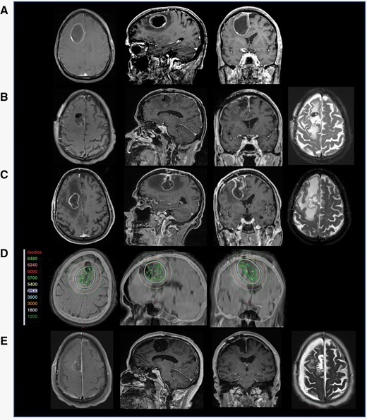 Illustrative example: rapidly recurring BM after surgical resection. A MRI with a right frontal contrast-enhancing lesion in a patient with stage IV squamous cell carcinoma, B The patient presented 22 days post-resection with recurrent left hemiparesis. MRI shows regrowth of contrast-enhancing lesion before the patient could undergo radiosurgery, C postoperative MRI following re-resection, and D Post-op T1 MRI and CT image registration displaying the GammaTile placement in the resection cavities with isodose lines (color-coded numbers represent isodoses in centigray = cGy), E 3-months follow-up MRI without evidence of local recurrence.