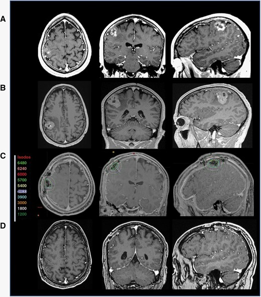 Illustrative example: radiation treatment of BM without significant interruption of targeted therapy. A MRI of a patient with EML4-ALK rearranged NSCLC who presented with progressive right-hand function. B MRI performed on the morning of surgery 2 weeks after initial MRI showing >25% increase in tumor volume. C Post-op T1 MRI with contrast and CT image registration displaying the GammaTile placement in the resection cavities after resection of both lesions with isodose lines (color-coded numbers represent isodoses in centigray = cGy). D Six months follow-up MRI post-GT placement showing no evidence of local recurrence or adverse radiation effect. The patient received alectinib, an ALK-targetingi therapy, up until a day prior to surgery and resumed therapy a day after the procedure without complications.