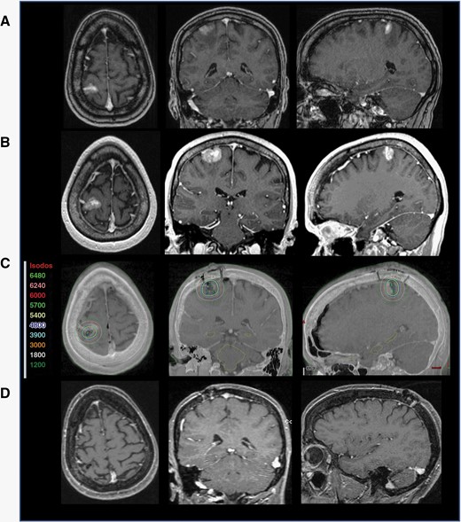 Illustrative example: subtotal resection of a rapidly growing BM. A MRI of a stage IV breast cancer patient who presented with progressive worsening of left-hand dexterity. B MRI performed on the morning of surgery 2 weeks after initial MRI showing >25% increase in tumor volume. C Post-op T1 MRI with contrast and CT image registration displaying the GammaTile placement in the resection cavities after resection of both lesions with isodose lines (color-coded numbers represent isodoses in centigray = cGy). D Twelve months follow-up MRI post-GT placement showing no evidence of local recurrence or adverse radiation effect. The patient received alectinib, an ALK-targetingi therapy, up until a day prior to surgery and resumed therapy a day after the procedure without complications.