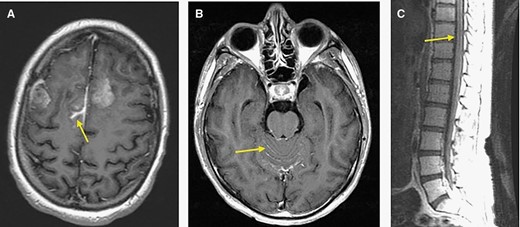 Imaging signs of LMD. (A) MRI from patient in the H3 G34 group (patient 19 in Table 2) showing peritumoral sulcal enhancement in the right parasagittal frontal lobe. (B) and (C) MRI of the brain (B) and spine (C) from a patient from the H3 K27 group (corresponding to patient 1 in Table 2) showing diffuse leptomeningeal enhancement in the cerebellar folia and brainstem surface as well as along the lower spinal cord and cauda equina.