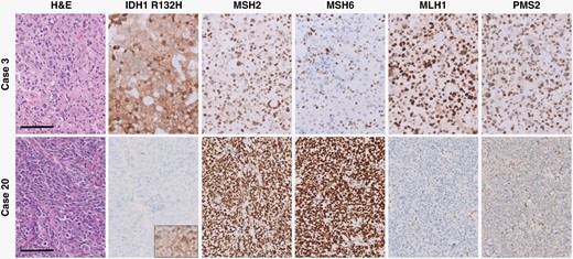 Histologic and immunohistochemical features of representative IDH-mutant astrocytoma and IDH-wild-type glioblastoma cases. There is loss of nuclear expression of MSH6 in tumor cells of the IDH-mutant case (case 3) and nuclear MLH1/PMS2 expression in tumor cells of the IDH-wild-type case (case 20), while background non-neoplastic cells have retained nuclear expression. All panels were taken at a total magnification of 200×. Scale bars = 100 µm.