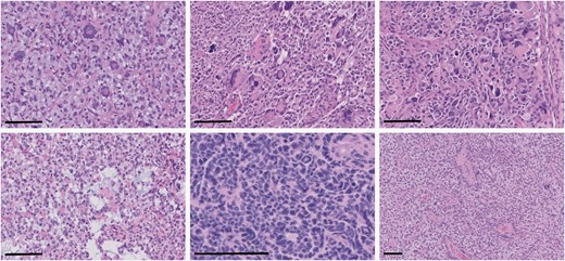 Representative examples of atypical histologic features identified in MMR-mutant diffuse gliomas. There were frequent multinucleated and bizarre giant cells (upper left and middle panels, total magnification 200×, scale bars = 100 µm), tripolar mitotic figures (upper right panel, total magnification 200×, scale bar = 100 µm), microcystic changes (bottom left panel, total magnification 200×, scale bar = 100 µm), primitive neuronal component (bottom middle panel, total magnification 400×, scale bar = 100 µm), and perivascular pseudorosettes (bottom right panel, total magnification 100×, scale bar = 100 µm).
