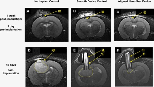 Representative T2-weighted MR images of U87MG model pre- and post- device implantation showing no adverse response to implant while confirming the possibility of noninvasive monitoring of tissue migration inside the device. (@: tumor, &: fluid, %: edge, **: flow voids, #: gradient). One week post-inoculation: (A) no implant control, (B) smooth film device control, (C) aligned nanofiber device. 12 days post-device implantation, (D) no implant control, (E) smooth film device control, and (F) aligned nanofiber device. In D, E, and F, tumor is surrounded by dotted white lines, bright white content inside device is fluid, and tissue inside device appears in gray tones. In (E), separation between tissue (gray) and fluid (white) is outlined by a dark edge between the two (%). Smooth film appears as a dark line at the center. In (F), inside the aligned nanofiber device, gray strips indicative of tissue appears along almost the entire length of device, and there is no well-defined edge separating the fluid inside the device from tumor. Flow voids (**) indicating interactions between tissue and fluid inside the aligned nanofiber device are visible.