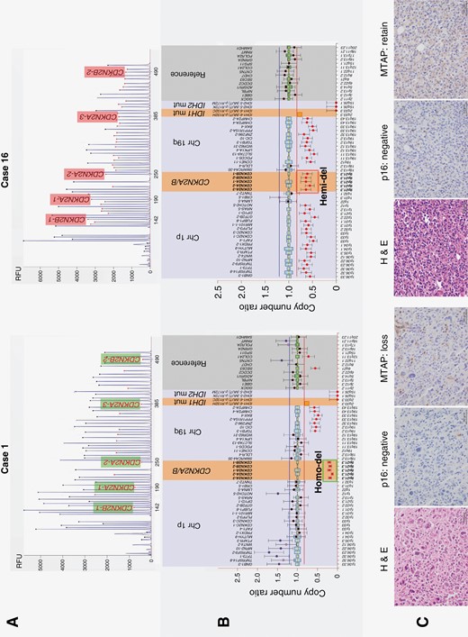 Representative examples of homozygous CDKN2A/B deletion (case 1) and hemizygous deletion (case 16). (A) Electrophoresis of multiplex ligation-dependent probe amplification (MLPA) using P088 probemix. (B) Ratio chart of copy number analysis. Case 1 presents with IDH 1 R132H mutant non 1p/19q-codeleted tumor with CDKN2A/B homozygous deletion. Case 16 presents with IDH 1 R132H mutant and 1p/19q-codeleted tumor with CDKN2A/B hemizygous deletion. (C) Histopathological findings. Hematoxylin and eosin staining and immunohistochemistry of p16 and MTAP are shown from left to right. Histologically, case 1 exhibits high-grade glioma cells with round to polygonal-shaped nuclei and prominent nuclear pleomorphism. Case 16 exhibits cellular proliferation of anaplastic glioma cells with rounded nuclei and perinuclear halo. Expression of p16 in cases 1 and 16 is classified as scale 0 and 1, respectively; both are evaluated as negative. MTAP expression is completely lost in case 1 and retained in case 16. CDKN2A/B, cyclin-dependent kinase inhibitor 2A/B; Chr, chromosome; H & E, Hematoxylin and eosin staining; Hemi-del, hemizygous deletion; Homo-del, homozygous deletion; IDH, isocitrate dehydrogenase; MTAP, methylthioadenosine phosphorylase; mut, mutant.