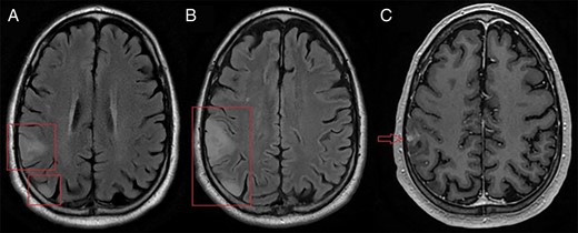 Axial magnetic resonance imaging. (A) T2 FLAIR imaging of 2 initial right parietal lobe masses. (B) T2 FLAIR imaging of the same masses, 3 months later. Both lesions infiltrate further into the parietal lobe and mild gyral swelling and effacement of adjacent sulci is seen. (C) Additionally, a nodular enhancing area is seen on the T1-weighted image.