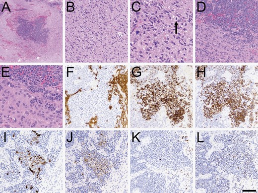 Histopathologic characteristics. (A) At low power, sharply demarcated islands of increased tumor cellularity were apparent. (B) Most of the tumor looked like a typical diffusely infiltrative high-grade glioma, including secondary structuring around neurons and mitoses (C, arrowhead). (D–E) Higher power views of the cellular islands showed cells with high nuclear: Cytoplasmic ratio, numerous mitoses, and abundant apoptosis. (F) The cellular islands were mostly negative for GFAP, although a few scattered cells were positive. The cellular islands were also variably positive for cytokeratin AE1/3 (G), CAM5.2 (H), cytokeratin 7 (I), and cytokeratin 20 (J). Some cells were positive for p63 (K) and TTF-1 (L). Scale bar in (L) = 500 microns in A, 50 microns in C and E, and 100 microns in B, D, and F-L.