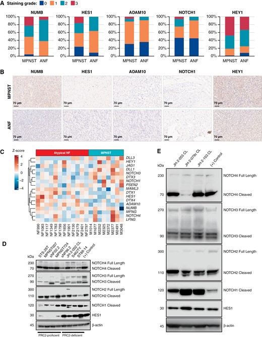 Gene expression analysis of patient ANF and MPNSTs reveals activation of the Notch pathway. (A) Visual grading of various NOTCH pathway effectors from TMA data using immunohistochemistry. (B) Representative images of TMA staining. The scale bar is 70 µm. All shown MPNSTs are scored as intensity 3 and ANFs are 0-1. Other examples of staining intensity can be found in Supplementary Figure S5. (C) Gene expression heatmap of NOTCH signaling pathway players across ANF (n = 12) and MPNST (n = 8) patient samples. Notch pathway players were probed in multiple (D) MPNST and (E) PDX cell lines. (+) control refers to MDA-MB-231 cells for all marks except HES1 and NOTCH3 where MCF7 cells were used.