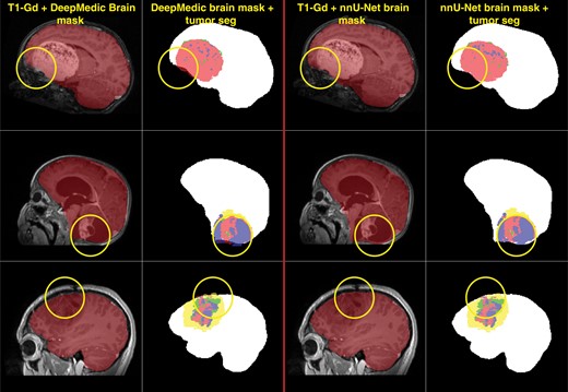 Examples of skull-stripping performance using the multi-parametric nnU-Net-based model compared to an earlier pediatric DeepMedic-based skull-stripping model. The nnU-Net-based model shows improved performance, successfully segmenting tumor regions that the DeepMedic-based model fails to include as part of the brain tissue.
