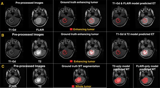 (A) and (B) Examples of brain MR images overlaid with ground truth segmentation labels and model-predicted enhancing tumor segmentation labels for T1-Gd and FLAIR, and T1-Gd and T2, respectively. (C) Results for the T2 or FLAIR model for segmenting whole tumor (WT).