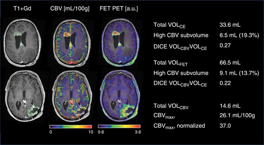 Delineation of tumor volumes and subvolumes. A case of multifocal recurrent glioblastoma. Scan was performed 1 month after resection of recurrence in left occipital lobe (8 months after end of radiotherapy). Axial sections are shown at the upper part of the lateral ventricles (upper row) and basal ganglia (lower row). The scan showed contrast enhancement at the primary tumor site in the left occipital region and appearance of 2 additional lesions (upper row) and second-line therapy was initiated. A subvolume of 6.5 mL showed high CBV and contrast enhancement corresponding to 19.3% of VOLCE. The high CBV subvolume within the metabolically active volume was 9.1 mL corresponding to 13.7% of VOLFET (see Figure 2 for definition of subvolume). Note good spatial agreement between modalities in the 2 lesions in the upper row, but low agreement in the occipital lesion in the lower row. Values shown are for all 3 components combined (and used in the analyses).
