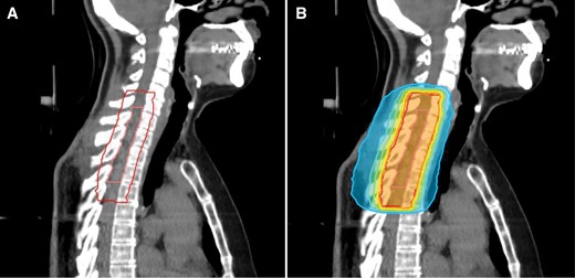 A treatment plan of a patient with spinal ependymoma CNS WHO grade 2 receiving postoperative radiotherapy after subtotal resection. Image A shows the area of resection (inner contour) and the planning target volume (PTV, outer contour) covering the resection area with an axial margin of 1.2 cm and a craniocaudal margin of 2.0 cm. Image B shows the dose distribution of the respective plan prescribed to 50.4Gy in 28 fractions. The inner orange isodose represents 95% of the prescription dose, yellow 90%, green 80%, turquoise 70%, and blue 50%.