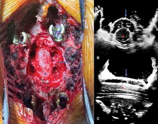 (A) Intraoperative photograph demonstrating separation surgery with circumferential decompression of the thecal sac (asterisk). Dorsal epidural tumor has been resected and the index-level pedicles have been removed bilaterally, thereby leaving the exiting nerve roots exposed (arrow) with access to the ventral epidural space. Axial (B) and sagittal (C) intraoperative ultrasound images taken after the decompression confirm circumferential decompression of the spinal cord (red asterisk) with reconstitution of the thecal sac as evidenced by the presence of the hypoechoic space between the thecal sac (blue arrow) and spinal cord (red asterisk).