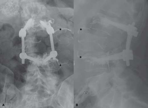 AP (A) and lateral (B) postoperative x-rays demonstrating the appearance of fenestrated screws with cement augmentation used in the spinal reconstruction portion of separation surgery. X-rays show cement extruded into the vertebral body at the L2 and L4 levels with the cement surrounding the distal screw circumferentially. Asterisks indicate endovascularly delivered embolisate placed preoperatively for embolization of this highly vascular tumor. AP = antero-posterior.
