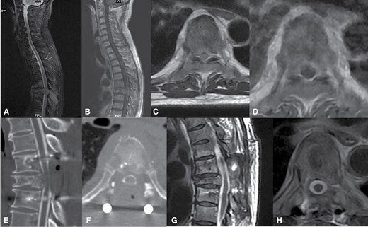 Fifty-nine-year-old male with salivary gland cancer presents with severe back pain found to have epidural spinal cord compression (ESCC) grade 3 at T7 on T2 sagittal (A) and axial (C) and T1 with contrast sagittal (B) and axial (D) demonstrating spinal cord compression without cerebrospinal fluid present around the spinal cord. He underwent separation surgery with posterolateral epidural decompression with partial thecal sac reconstitution and stabilization with T6-8 posterior segmented fusion with cement augmentation on CT myelogram sagittal (E) and axial (F) followed by postoperative spine stereotactic radiosurgery. Postoperative MRI sagittal (G) and axial (H) shows complete thecal sac reconstitution with decompression of the spinal cord.