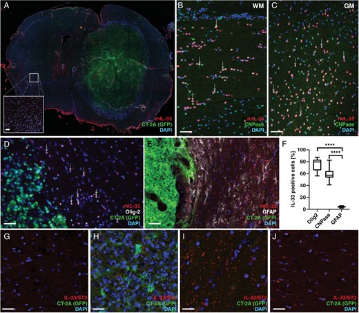 IL-33 expression in the tumor microenvironment of mouse glioma models. (A) Immunohistochemical analysis showing IL-33 expression in the mouse brain with CT-2A tumor cells. IL-33 expression in the contralateral hemisphere (A, insert). (B-C) Co-expression of IL-33 and CNPase in the white matter of the corpus callosum (WM, B), and in the gray matter of the cortex (GM, C). (D) Co-localization of IL-33 with Olig2 or (E) GFAP. (F) Quantification of co-localization of IL-33 with Olig2, GFAP or CNPase in the tumor brain. (G-J) Proximity ligation assay detects protein complexes formed by IL-33 and ST2 in CT-2A glioma. (G) control brain, (H) tumor core, (I) area surrounding the tumor, and (J) contralateral hemisphere. Results are representative of three biological replicates with 6 mice per group in each repeat. Data are presented as mean ± SD, ****P < .0001. Scale bar 50 µm.