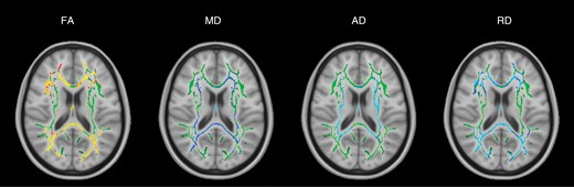 TBSS results for the group of all 8 posterior fossa tumor patients at the presurgical time point. Green denotes the white matter skeleton where voxels are not significantly different between the patient and control groups. The yellow to red color scale denotes voxels that are significantly decreased in the patient group and the light blue to blue color scale denotes voxels that are significantly increased in the patient group. Significant P-values for FA are <.05 (yellow values are <.01). Significant P-values for MD are < .05 (light blue values are <.015). AD P-values are <.03 (light blue values are <.005). RD P-values are <.05 (light blue values are <.005).