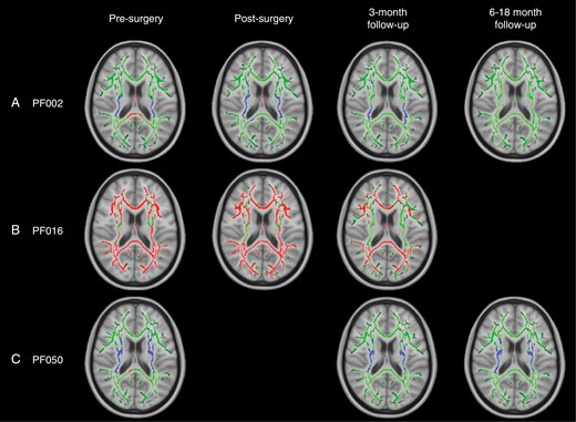 TBSS results for individual patients with widespread, significant changes in FA, including pilocytic astrocytoma patients PF002 (A) and PF016 (B) and medulloblastoma patient PF050 (C). Green corresponds to the white matter skeleton where voxels are not significantly different between the individual patient and group of controls. Red voxels correspond to areas of the white matter skeleton that are significantly decreased in the patient (P-value < .05), and blue voxels are significantly increased in the patient (P-value < .05). From left to right, the image timeline is from presurgery, postsurgery, follow-up at 3 months and a further follow-up at 6–12 months (as in Table 1).