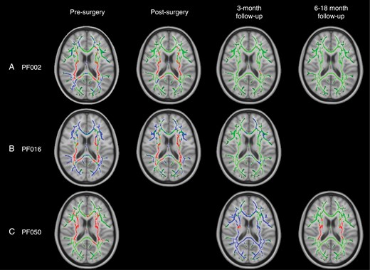 TBSS results for individual patients with widespread, significant changes in ODI, including pilocytic astrocytoma patients PF002 (A) and PF016 (B) and medulloblastoma patient PF050 (C). Green corresponds to the white matter skeleton where voxels are not significantly different between the individual patient and group of controls. Red voxels correspond to areas of the white matter skeleton that are significantly decreased in the patient (P-value < .05), and blue voxels are significantly increased in the patient (P-value < .05). From left to right, the image timeline is from presurgery, postsurgery, follow-up at 3 months and a further follow-up at 6–12 months (as in Table 1).