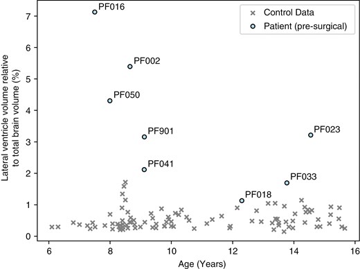 Comparison of the lateral ventricle volumes relative to the total brain volume (%) and age (years) of the patients at the presurgical time point and all controls.