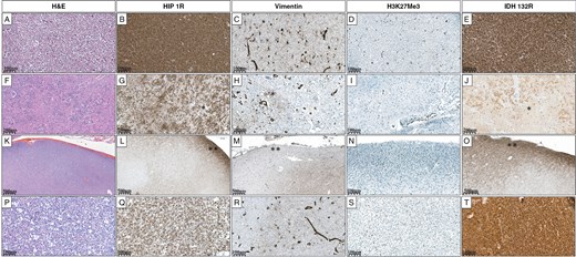 Grade 2 oligodendroglioma (A) shows diffuse HIP1R positivity (B), is negative for Vimentin (C), and exhibits complete loss of H3K27me3 (D). IDH1 R132H is diffusely positive (E). Oligodendroglioma (F) showing heterogeneous HIP1R positivity attributed to white matter* fragments (G). Vimentin is focally positive in white matter* and negative in tumor cells (H). H3K27me3 is completely lost (I). IDHR132 H positivity is variable due to white matter* (J). Cortical infiltrating oligodendroglioma (K) with diffuse HIP1R positivity in the subpial region** and patchy positivity in the underlying cortex (L). Vimentin is negative in the subpial region** and shows focal positivity in the underlying cortex (M). H3K27me3 is completely lost (N). IDH1 R132 H is diffusely positive in the subpial region** highlighting a few tumor cells in the underlying cortex (O). A case of Oligodendroglioma (P), HIP1R is diffusely positive (Q), Vimentin is negative but highlights the reactive astrocytes (R), H3K27me3 is completely lost (S), and IDHR132 H is diffusely positive (T).