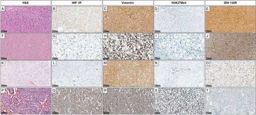 Grade 3 astrocytoma (A) shows focal HIP1R positivity (B), diffuse Vimentin positivity (C), complete loss of H3K27me3 (D), and positive IDH1 R132H expression (E). Grade 2 astrocytoma (F) shows sparse HIP1R positivity (G), focal Vimentin positivity (H), partial loss of H3K27me3 (I), and positive IDH1 R132H expression (J). Another Grade 2 astrocytoma (K) is negative for HIP1R (L), shows diffuse Vimentin positivity (M), complete loss of H3K27me3 (N), and positive IDH1 R132H expression (O). Glioblastoma (P) shows diffuse HIP1R positivity (Q), diffuse Vimentin positivity (R), retained H3K27me3 expression (S), and is negative for IDH1 R132H (T).