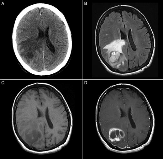 (A) Unenhanced CT, (B) T2-weighted FLAIR, (C) gradient echo T1-weighted, and
                        (D) post-gadolinium spin echo T1-weighted images depict a relatively
                        circumscribed mass in the left superior temporal lobe with both solid,
                        enhancing components and some cystic or necrotic areas. Moderate edema
                        signal surrounds a portion of the mass.