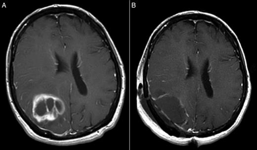Post-gadolinium spin echo T1-weighted images (A) before and (B) after
                            surgery.