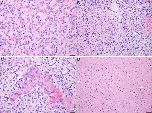 The biopsies demonstrated an infiltrating population of atypical astrocytic
                        cells, showing (A) brisk mitotic activity, (B) tumor necrosis, and (C)
                        microvascular proliferation, consistent with a diagnosis of glioblastoma. A
                        biopsy from the periphery of this mass may show (D) a low-to-moderately
                        cellular tumor, with or without mitoses, corresponding to a lower
                        histological grade. In images (A) and (C), photographed at 400×
                        magnification, the scale bars on the bottom right represent 20 µm. In images
                        (B) and (D), photographed at 200× magnification, the scale bars represent 50
                        µm.