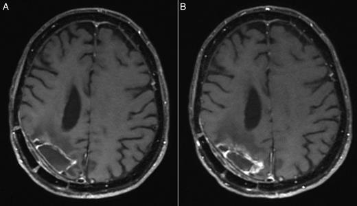 (A) The first MRI following chemoradiotherapy and (B) MRI evidence of tumor
                        progression approximately 2 years later. Both are post-gadolinium spin echo
                        T1-weighted images.