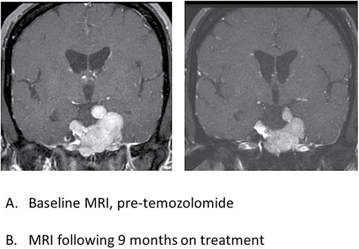Postcontrast T1-weighted coronal MR images of patient 4 showing radiographic response to temozolomide treatment. Panel A (left) is the baseline MRI prior to start of temozolomide and Panel B (right) is an MRI performed following 9 months of treatment with temozolomide, showing regression of the tumor and reduced mass effect on the optic nerves and chiasm.