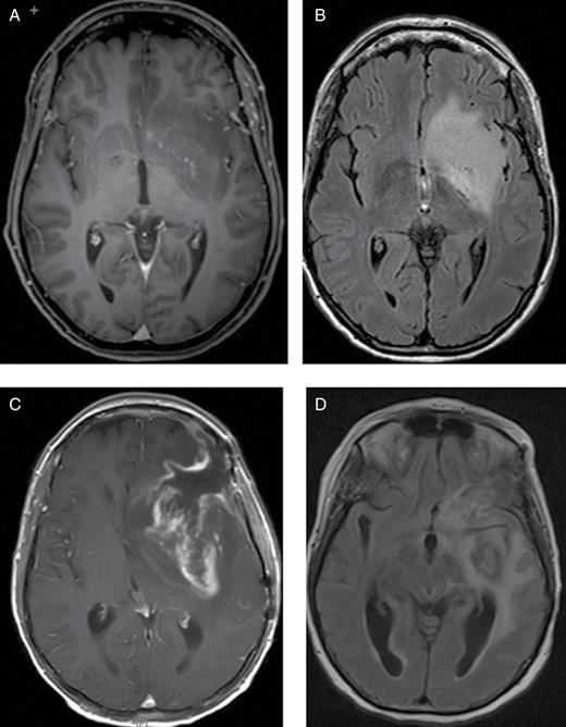 Case 1. MRI brain: axial T1 postcontrast (A) and FLAIR (B) images at the time of diagnosis shows a predominantly non-enhancing lesion in the left frontotemporal area. Note midline shift and increasing vasogenic edema in the left frontotemporal at the time of progression as seen on axial T1 post contrast (C) and FLAIR (D) images. The patient did not respond to steroids and did not receive bevacizumab. She progressed clinically and required specialized institutional nursing care for several months before she died.