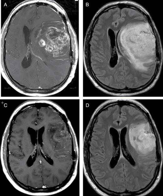Case 2. MRI brain: axial T1 postcontrast (A) and FLAIR (B) images at the time of progression and admission to hospital shows significant midline shift secondary to tumor growth and surrounding vasogenic edema. The patient received bevacizumab during inpatient admission and rapidly improved both clinically and radiographically. Corresponding MR images of the brain show significant reduction of the enhancing tumor volume, decrease in vasogenic edema and reversal of the midline shift after 3 doses of bevacizumab (C, D).