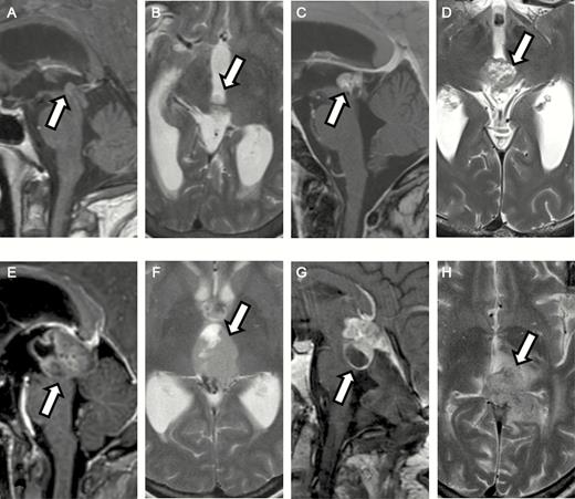 MRI of cases 1 to 4. Contrast-enhanced T1-weighted sequence, A, C, E, and G, sagittal view, and T2-weighted sequences, B, D, E, and H, axial view. A and B, In case 1, a well-marginated small lesion appears with only faint contrast enhancement. C and D, In case 2, a contrast-enhancing lesion appears with multiple small cysts. E and F, In case 3, a large intraluminal mass appears with only partial contrast enhancement. G and H, In case 4, a contrast-enhancing mass appears with cystic parts and infiltration in the brain parenchyma and surrounding edema.