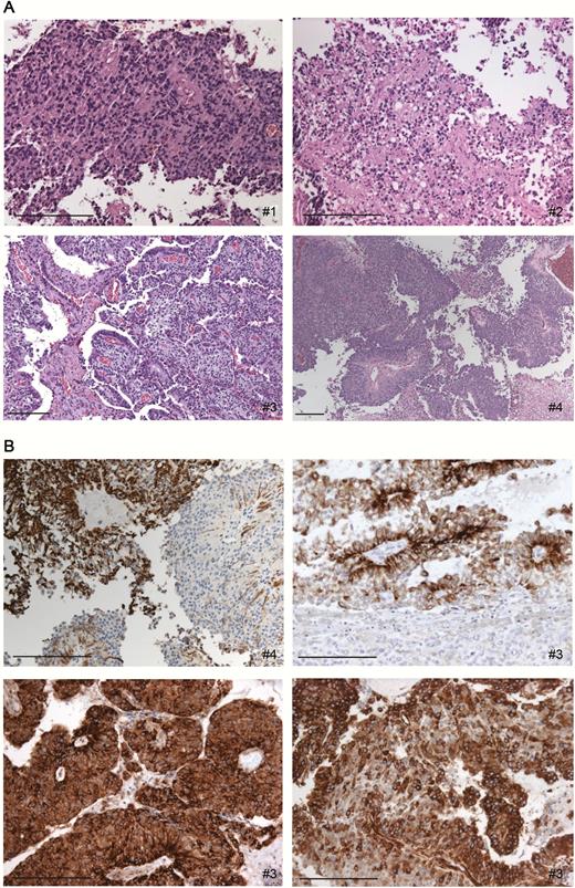Histology and immunohistochemical analyses. A, Histological sections of cases 1 to 4 highlight morphological patterns (hematoxylin and eosin, scale 200 µm). B, Representative immunohistochemical stainings (top left: pan cytokeratin, top right: glial fibrillary acid protein) and expression of mammalian target of rapamycin pathway (bottom left: phosphor-mammalian target of rapamycin, bottom right: phosphor-S6) appear in the majority of tumor cells of case 3 with phosphatase and tensin homolog missense mutation (scale 200 µm). Complete immunohistochemical staining profiles of cases 1 to 4 are available as Supplementary Table 1 and Supplementary Figure 1.