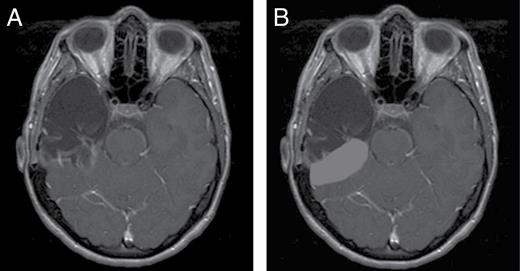 A, Complete temporal lobectomy—remove tumor with temporal cortex, amygdala, and hippocampus adjacent to the ambient cistern. B, Partial cavity radiotherapy—include only the parenchymal resection bed while omitting the dural resection bed.