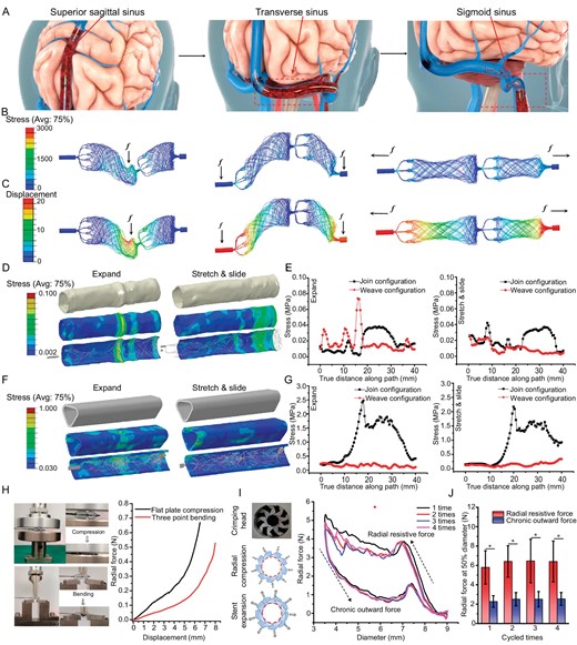 Mechanical evaluation of the Venus-TD. (A) Schematic illustration of thrombus removal by using the Venus-TD from the superior sagittal sinus (SSS), transverse sinus (TS) and sigmoid sinus (SS). (B) The von Mises stress and (C) the displacement contour plots from computational modeling of the devices with weave configurations under different mechanical scenarios. The von Mises stress distribution on the internal jugular vein (IJV) (D and E) and SSS (F and G) vessels walls induced by the expanding and stretching/sliding of the device, as well as the related values along the vessels compared with join configuration. (H) Photos and force-displacement curves of the stent under flat plate compression and three-point bending. (I) Photos of the crimping head and schematics of the radial compression and stent expansion. The circumferential radial force-stent diameter curves of the stent after four load–unloading cycles. (J) The radial force of the stent that had been compressed to 50% of its labeled diameter was recorded at different cycles. The related point position is depicted in Fig. S9. *P < 0.05.