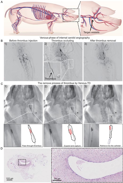Thrombectomy process in swine models. (A) Illustration of swine cerebral vessels and the targeted jugular veins for thrombus occlusion. (B) The modeling and thrombectomy processes were evaluated by using the venous phase of the digital subtraction angiography (DSA) images of the swine left IJVs (1) before the thrombus injection, (2) after the thrombus occlusion and (3) after thrombus removal. (C) Detailed demonstration of the thrombectomy process by using DSA images: (1) passed through the thrombus, (2) expanded to capture the thrombus and (3) retrieved into the catheter. (D) The hematoxylin–eosin staining images of the IJV.