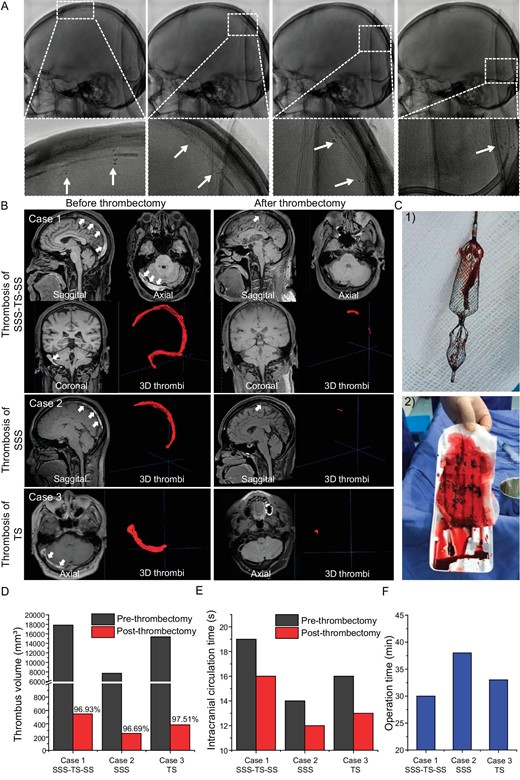 Thrombectomy process in CVST patients. (A) The continuous fragmentation and removal of thrombus along the SSS and torcular herophili are displayed by using DSA and the white arrows indicate the stent markers. (B) For Case 1, the MRBTI demonstrated a isointense and hyperintense mix in the SSS, right TS and SS (white arrowheads) and 3D thrombi were delineated semi-automatically by using software; the followed-up MRBTI after thrombectomy demonstrated complete recanalization of the occluded vessels. Cases 2 and 3 are CVST patients with thrombosis in the SSS and TS, respectively. (C) Optical photos of (1) the retrieved Venus-TD and (2) the removed thrombus from the patient. Their (D) 3D thrombus volume and (E) intracranial circulation time are quantitatively displayed before and after thrombectomy. (F) The operation time of the thrombectomy procedure by using the Venus-TD in these three cases.