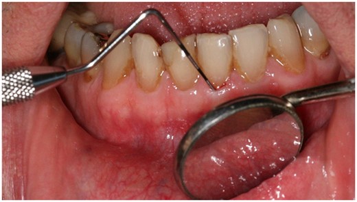 The test for gingival bleeding tendency sensitive to ascorbic acid (AA) depletion and repletion consists of inserting a thin probe between the gingival cuff and the tooth at multiple sites and observing an onset of bleeding after retracting the probe. Such an increased gingival bleeding tendency can be common in patients who do not self-report bleeding after flossing or brushing their teeth. This measure of gingival bleeding tendency is referred to as bleeding on probing in the dental literature and was reported in 1940 as a sensitive diagnostic marker for a vitamin C deficiency.32 Other gingival measures such as bleeding on simple palpation of the gingiva or spontaneous gingival bleeding can be markers of advanced scurvy (i.e., severe vitamin C depletion) but not of mild to moderate vitamin C depletion
