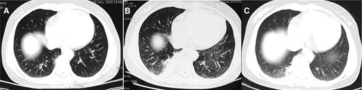 Computed tomographic images from a 49-year-old woman (case 4), with a history of pigeon contact and onset of fever. A, Image obtained on day 1 after onset of symptoms shows fibrous foci in the right lower lobe. B, Image obtained on day 4 after onset of symptoms shows consolidation in the right lower lobe (empiric treatment with cephalosporin antibiotics for 3 days). C, Image obtained on day 11 after onset of symptoms shows consolidation decreased compared with before in the right low lobe (treatment with moxifloxacin for 7 days).