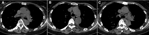 Computed tomographic images from a 61-year-old woman (case 7) with onset of fever. The images show mediastinal lymphadenectasis.