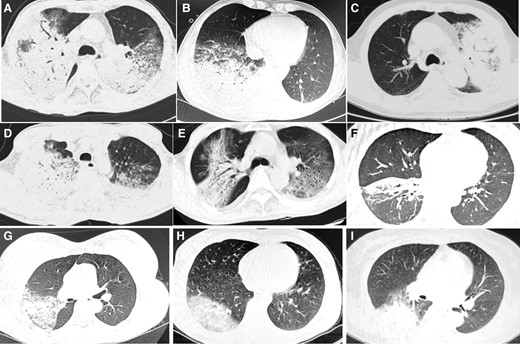 Computed tomographic scan showing consolidation in patients with psittacosis pneumonia.