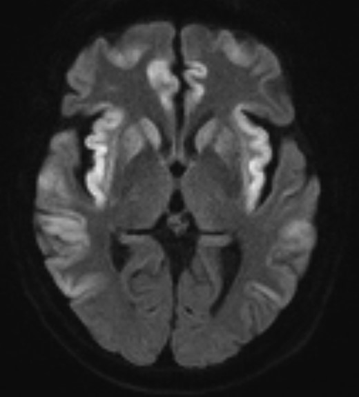 Magnetic resonance diffusion-weighted imaging of the brain of the cardiac recipient at day 24 posttransplant demonstrating changes of hyperammonemic encephalopathy: symmetrical cortical edema and diffusion restriction in the basal ganglia, insula cortex, cingulate cortex, temporal lobes, and frontal lobes, and sparing of the occipital lobes.