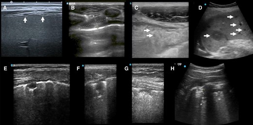 Ultrasound case studies. A, Female in her 40 s, DM–, HIV–, MRS+ with numerous small peritoneal nodules seen from transcostal view. B, C, Man in his 20s, eMRS+, internal mammary enlarged lymph node (1.9 × 0.8 cm) (B), and omental cake with hypoechoic inclusions (C, inclusions single arrows). D, Female in her 20s, after kidney transplant 5 y ago with unlikely TB and disseminated bartonellosis (tissue-PCR positive) with numerous small and large hypoechoic spleen lesions (maximum 2.8 cm). E + F: Female in her 40s, HIV+, post-TB with irregular treatments in the past, now MRS+ (pre-XDR), widespread SPC < 1cm and SPC ≥ 1cm with single SPC showing oval shape (E), other lesions resembled shreds (F). G + H: Man in his 40s with large cell neuroendocrine lung carcinoma with pulmonary aspergillosis with SPC < 1cm (G) and SPC ≥ 1cm (H, curved array). Abbreviations: CRS, composite reference standard; DM, diabetes mellitus; eMRS, extended microbiological reference standard; MRS, microbiological reference standard; SPC, subpleural consolidation; TB, tuberculosis; XDR, extensively drug resistant.
