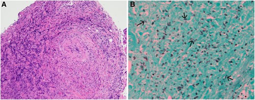 Supraglottic biopsy. (A) The image shows ulceration with loss of surface epithelium. Beneath is marked acute and chronic inflammation with necrotic cellular debris throughout the biopsy. Perivascular inflammation is prominent. No definitive granulomas are identified. The absence of granuloma formation may be attributed to the patient's use of a tumor necrosis factor-alfa inhibitor (hematoxylin and eosin, 10×). (B) Gomori-methanamine silver stain highlights abundant small oval yeast forms with occasional narrow-based budding. No pseudohyphae are identified. The histologic differential was narrowed to histoplasmosis, cryptococcosis, and emergomycosis. The mucicarmine stain was negative, which ruled out classic Cryptococcus. The clinical picture was not consistent with emergomycosis. ©2024 Ellen Giampoli