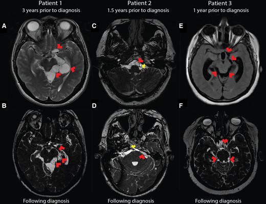 Brain imaging of patients over time. Earliest available MRI for each patient as compared with a BFFE sequence obtained following diagnosis demonstrates high resolution of the subarachnoid neurocysticercosis involvement. A, Patient 1 three years prior to diagnosis. T2 fast recovery fast spin echo sequence shows large cystic lesions throughout the left perimesencephalic space and along the left middle cerebral artery (red arrowheads), interpreted at the time as a benign arachnoid cyst. B, Patient 1 BFFE MRI following diagnosis shows partially collapsed membranes (red arrowheads) in the same locations as previously seen mass lesions. C, Following shunt placement, patient 2 did undergo a high-resolution MRI scan (fast imaging employing steady-state acquisition) 1.5 years prior to diagnosis, but cysts in the basilar cisterns were missed, including the cyst (red arrowhead) abutting the basilar artery (yellow arrowhead). D, Patient 2 following diagnosis underwent BFFE MRI, again showing a cyst near the basilar artery (yellow arrowhead) and others, including the cyst in the cerebellopontine angle (red arrowhead). E, T2 fluid-attenuated inversion recovery sequence of patient 3 one year prior to diagnosis illustrates ventriculomegaly and a subtle mass effect in the perimesencephalic space and around the origin of the left middle cerebral artery (red arrowheads). F, Patient 3 underwent shunt placement, and after the diagnosis was made, BFFE MRI revealed adhesions and cysts in the perimesencephalic space and the suprasellar cistern (red arrowheads). BFFE, balanced fast field echo; MRI, magnetic resonance imaging.