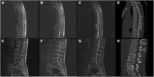 Magnetic resonance (MR) imaging and computed tomographic (CT) results on a 49-year-old man with spinal brucellosis. Sagittal T1-weighted (A, E) and T2-weighted (B, F) MR images show T9, T10, L2, L3, L4, and L5 vertebral body hypointensity and slight hyperintensity, respectively. C, G, T2-weighted fat-suppression images display hyperintensity in the infected vertebrae. D, H, CT sagittal reconstruction shows T9, T10, L2, L3, L4, and L5 vertebral body destruction and intervertebral space narrowing caused by infection.