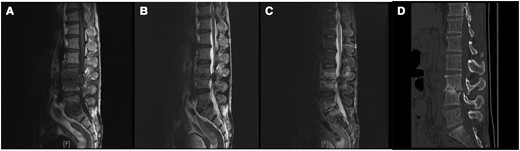 Magnetic resonance (MR) imaging and computed tomographic (CT) results in a 57-year-old man with spinal brucellosis. A–C, Sagittal T1-weighted (A) and T2-weighted (B) and T2-weighted fat-suppression (C) MR images show multiple abnormal signals in L3, L4, L5, and S1 vertebral body levels. D, CT sagittal reconstruction indicated L3 and L4 vertebral body destruction and intervertebral space narrowing.