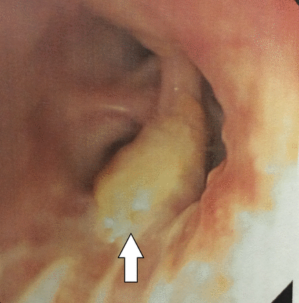 Fungal tracheobronchitis consistent with invasive aspergillosis.