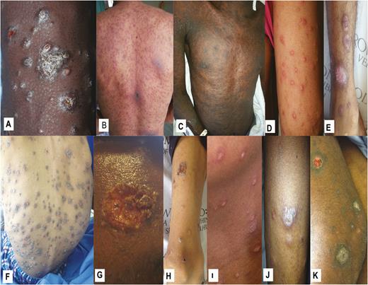 Selected cutaneous lesions of persons with advanced HIV infection and generalized, recent-onset skin lesions suspicious for systemic mycoses. Lesions shown are from patients with proven systemic mycoses caused by Emergomyces africanus (A–E), Sporothrix schenckii (F–H), and Histoplasma capsulatum (I–K).